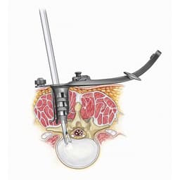 Spine Classics MLD System-Product Picture Enlargement CW